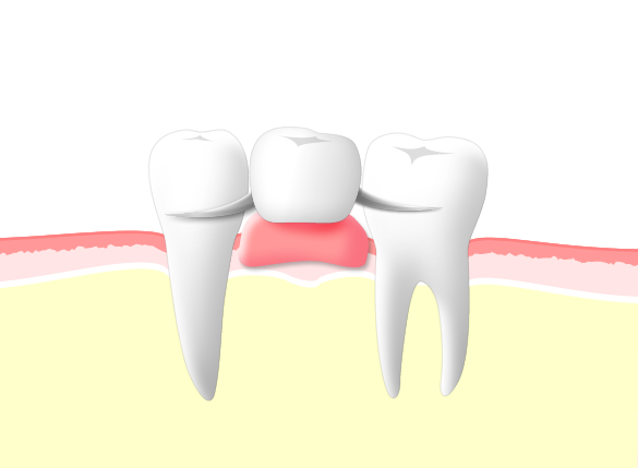 他の歯を削らず保険診療をご希望される方には、入れ歯がお勧め